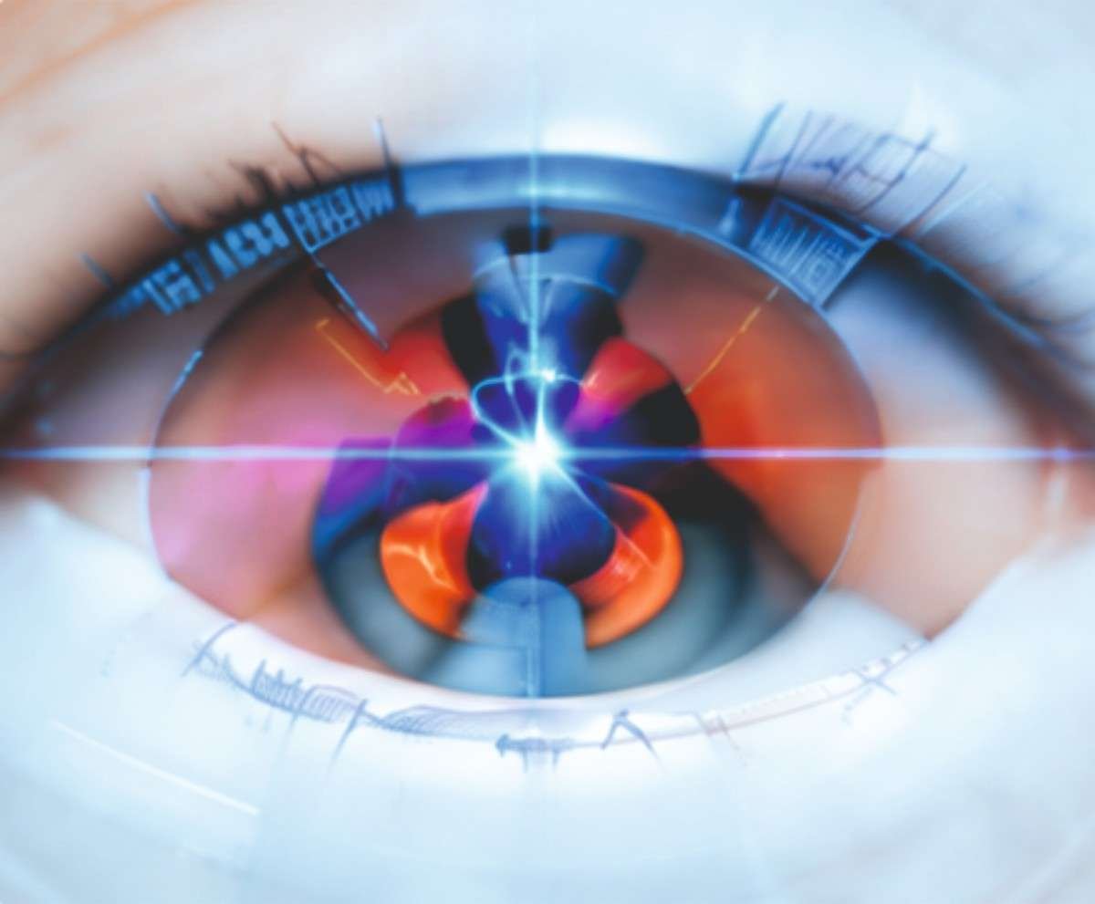 LASIK-Surgery